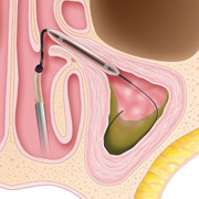 Balloon Sinuplasty - Step 2