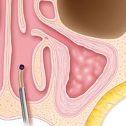 Balloon Sinuplasty - Step 4