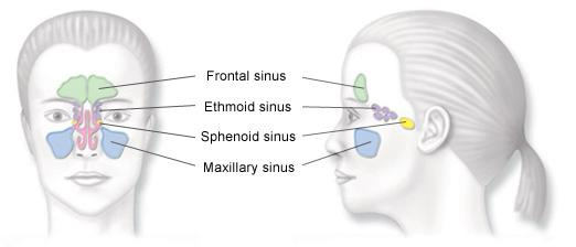 Sinusitis 